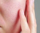 Các hoạt chất cải thiện lỗ chân lông to và lưu ý khi sử dụng