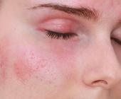 Dấu hiệu dị ứng khi đắp mặt nạ và cách xử lý