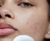 Hướng dẫn cách lựa chọn treatment cho da nhạy cảm