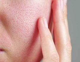 Các hoạt chất cải thiện lỗ chân lông to và lưu ý khi sử dụng