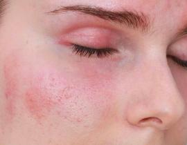 Dấu hiệu dị ứng khi đắp mặt nạ và cách xử lý