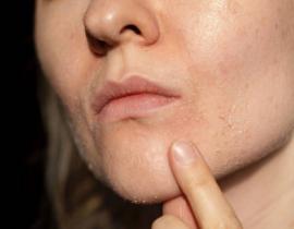 Dùng Retinol có nhất định phải bong da? Cách sử dụng Retinol hiệu quả cho làn da