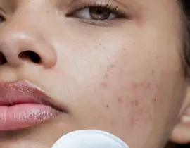 Hướng dẫn cách lựa chọn treatment cho da nhạy cảm