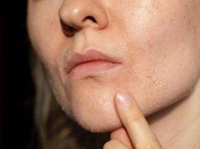 Dùng Retinol có nhất định phải bong da? Cách sử dụng Retinol hiệu quả cho làn da