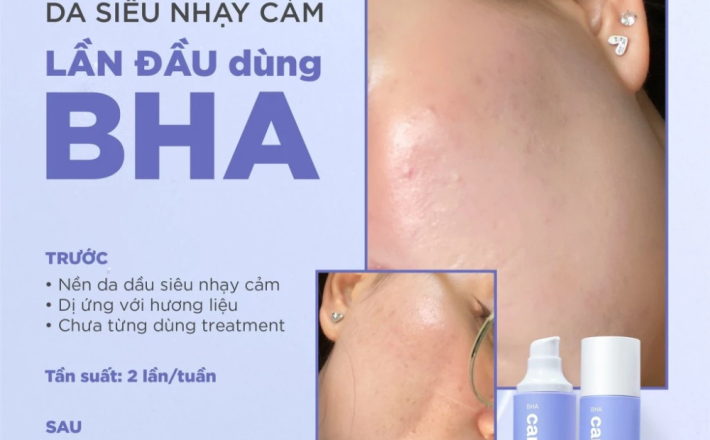 Hoạt chất BHA tẩy tế bào chết và thông thoáng lỗ chân lông - CANDID BHA Gel Exfoliant 100ml