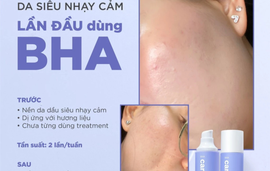 Hoạt chất BHA tẩy tế bào chết và thông thoáng lỗ chân lông - CANDID BHA Gel Exfoliant 100ml