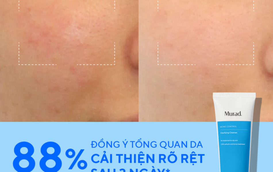 Sữa Rửa Mặt Làm Sạch Ngừa Mụn - Murad Clarifying Cleanser 148ml